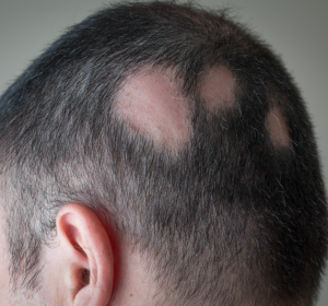 Haarausfall: Kombi-Behandlung oft auch mit Kombi-Präparaten